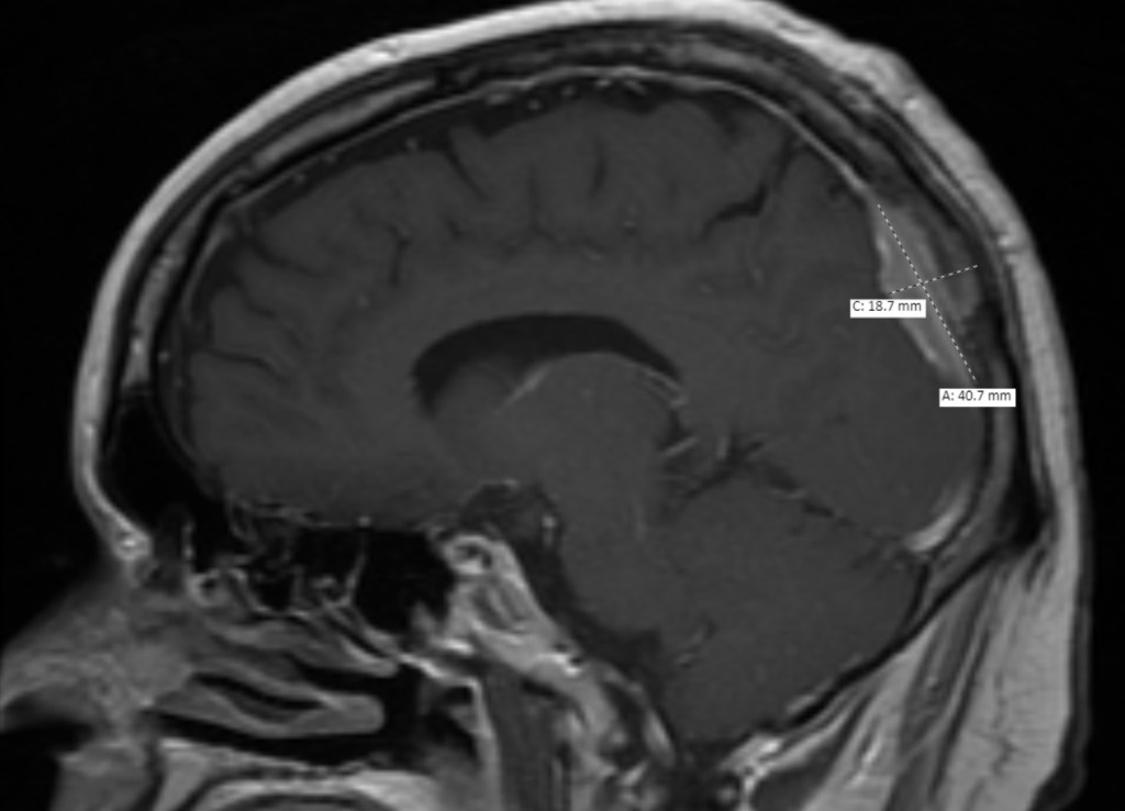 To remind everyone about the size and location of the tumor