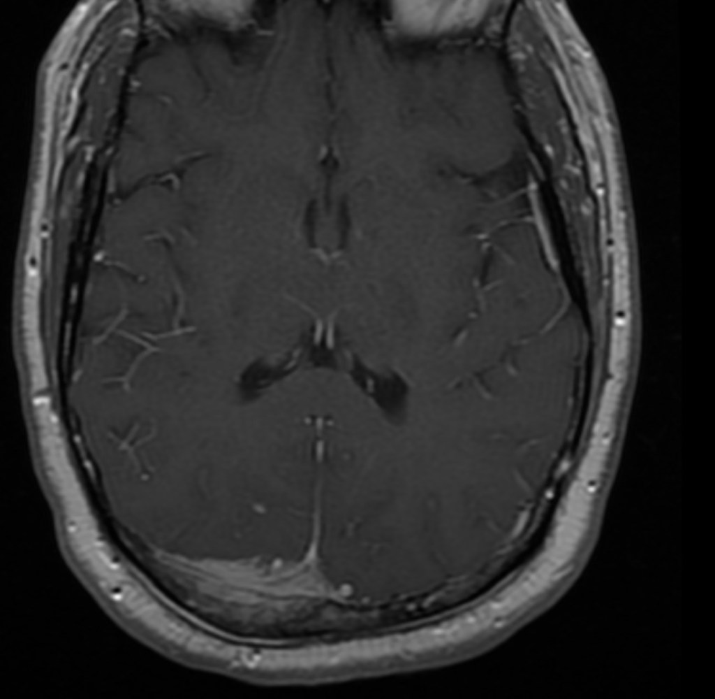 The tumor from the above view